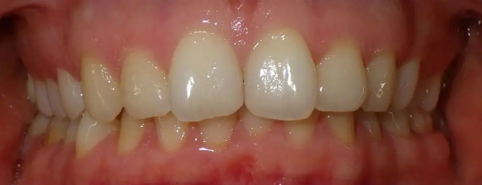 CAN A Hawley Retainer Correct Overbite