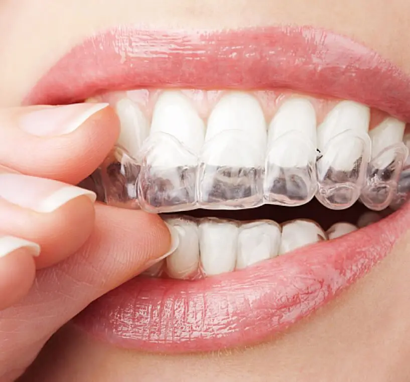 Diamond or Diamond Plus Invisalign Provider​