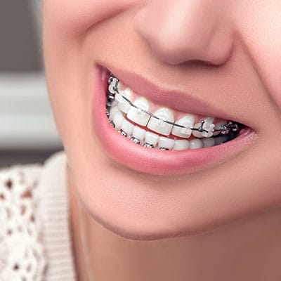 ceramic braces near you astoria queens