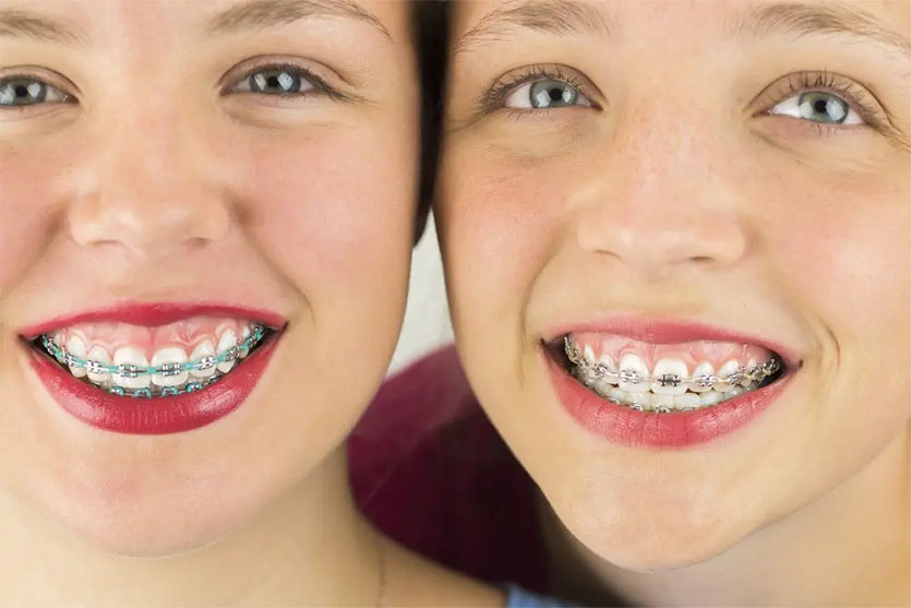 What Are The Best Braces Colors