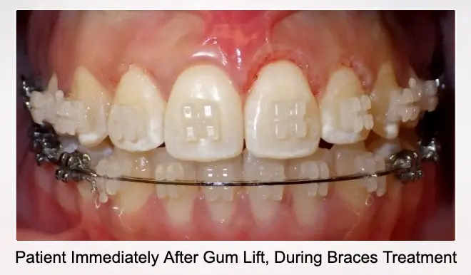 after gum lift during braces