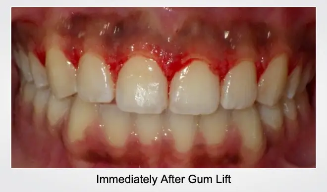 after gum lift