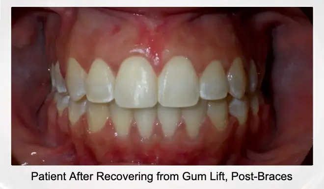 after recovery post braces