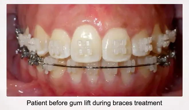 before gum lift during braces