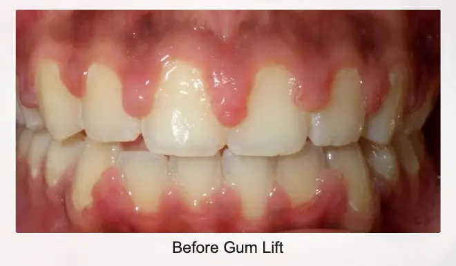 before gum lift