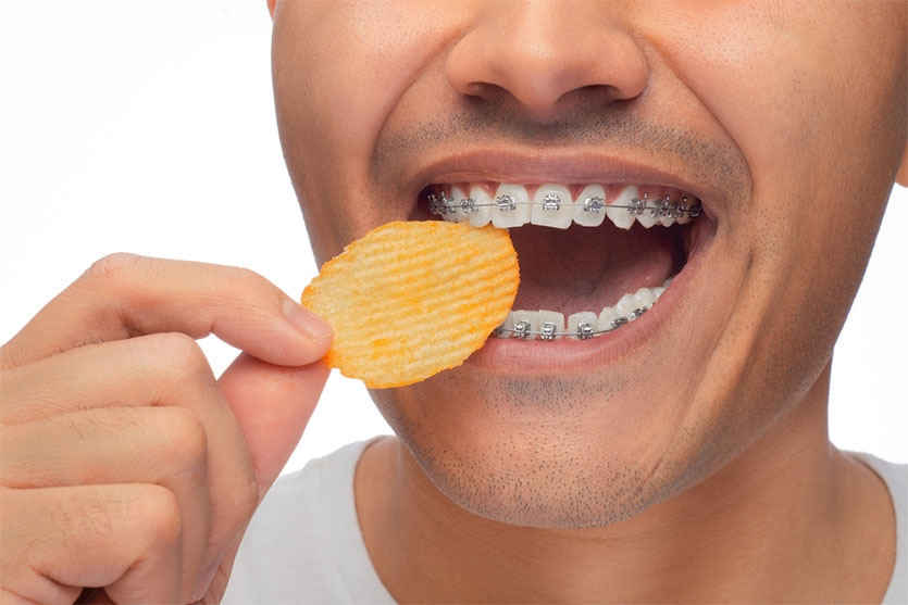 WHAT TYPES OF Chips Can You Eat with Braces