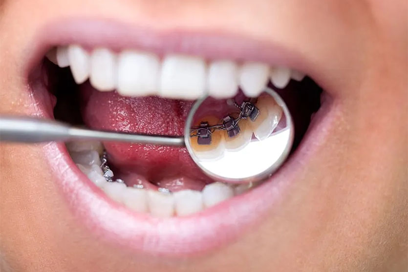 lingual braces