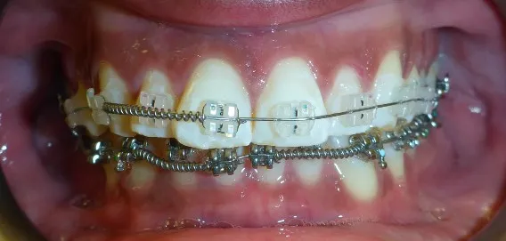 CERAMIC BRACES: Results You Can See from Treatment You Can't