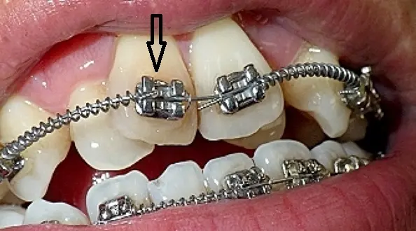 diamondbraces patient elastic band fallen off