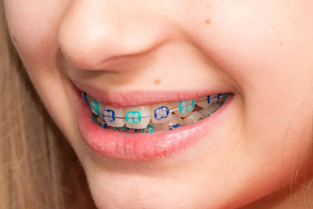 ARE Ceramic Braces Safe