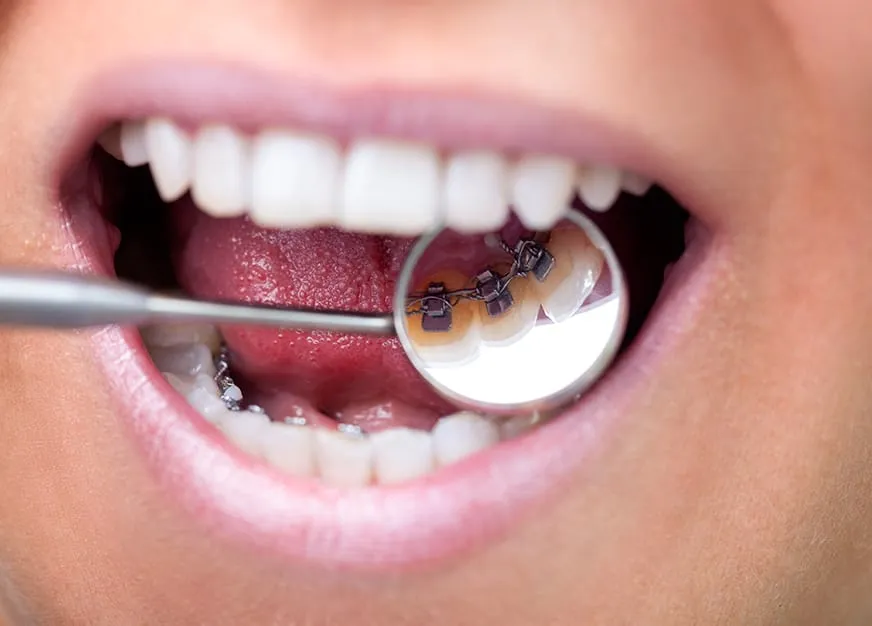 LINGUAL BRACES: Treatment That Works Behind the Scenes