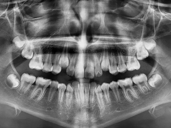 USING X-RAYS FOR Orthodontic Care: Imaging to Show the Full Dental Picture