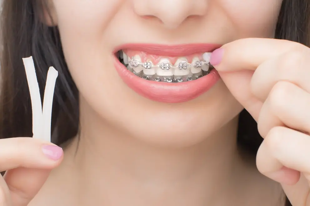 smiling woman with braces applies orthodontic wax