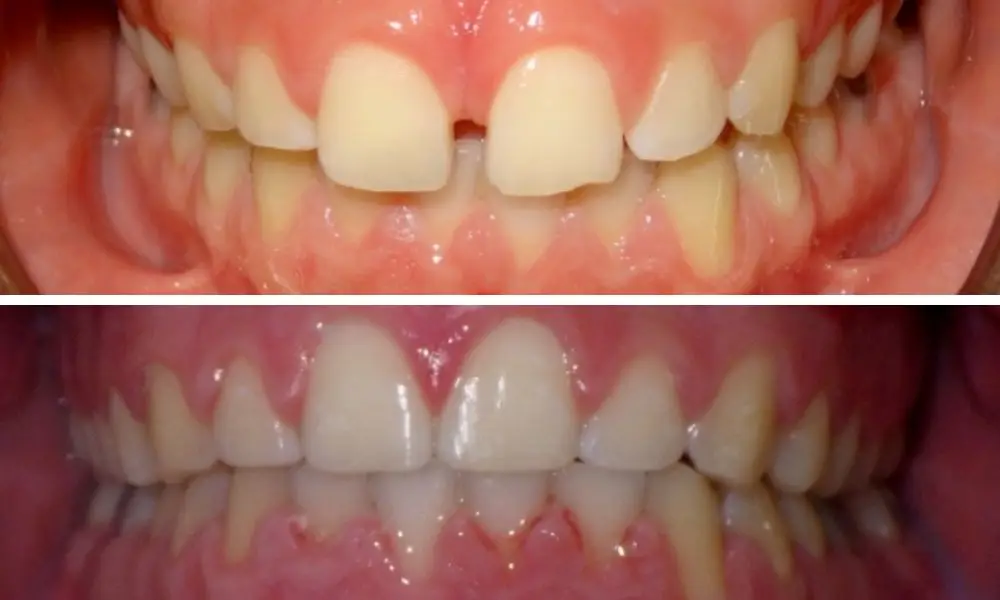 BRACES TREATMENTS, Before and After