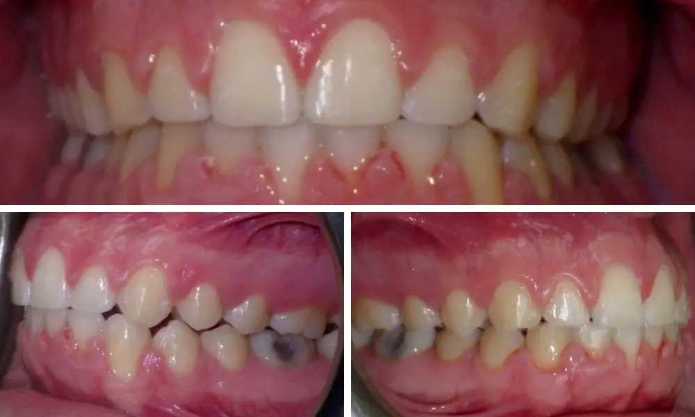 Can Invisalign Aligners Correct an Overbite?