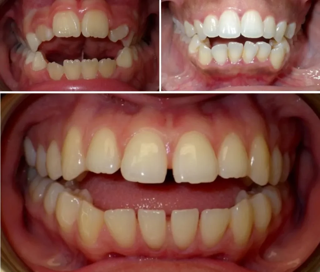 Does Invisalign Treatment Correct Open Bite?