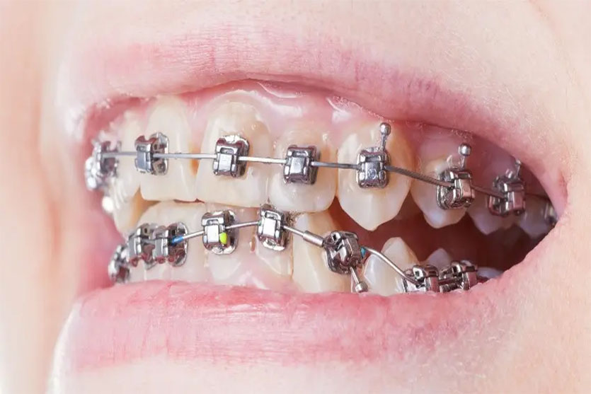 self litigating braces treatment