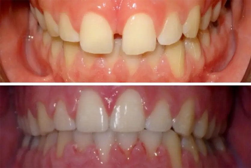 Braces Before And After Header