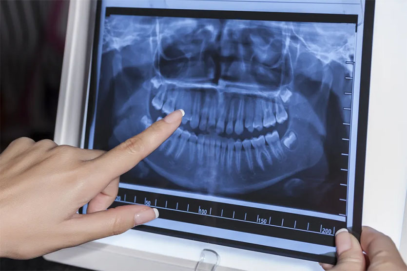 WHAT ARE Digital Dental X-Rays