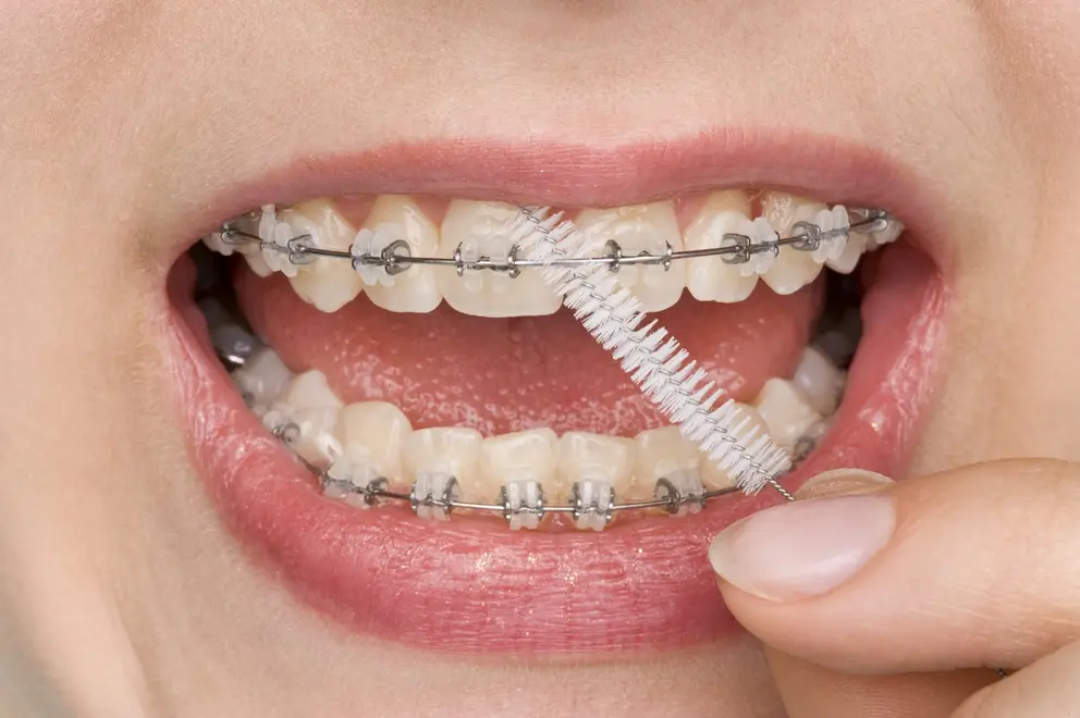 ¿DE QU ? ESTÁN HECHOS los brackets de cerámica?