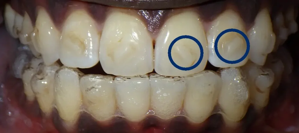 smartforce invisalign attachments