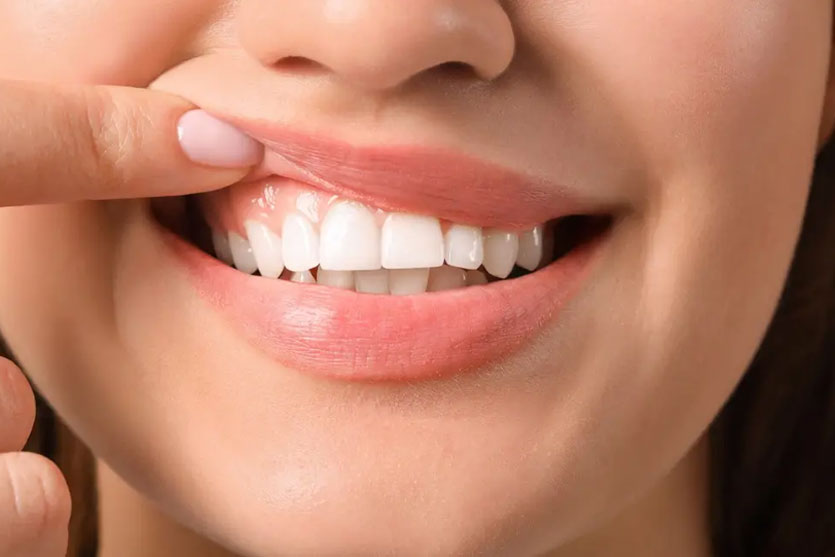 HOW LONG DO Mail-Order Aligners Take to Straighten Teeth