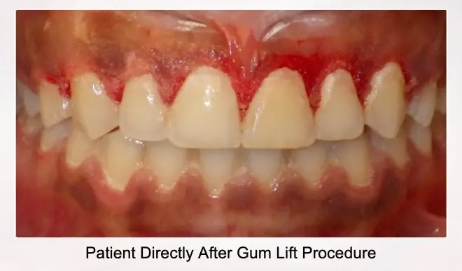 patient after gum lift