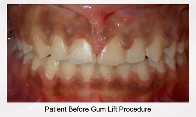 patient before gum lift