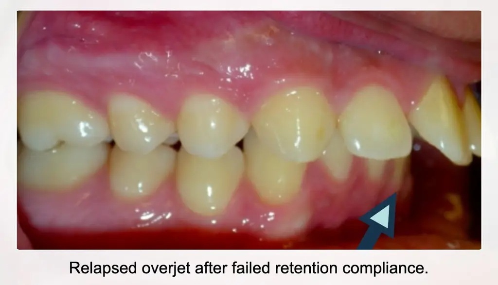 WHY Do Your Teeth Shift