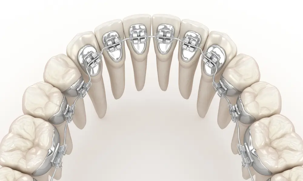 d model of lingual braces