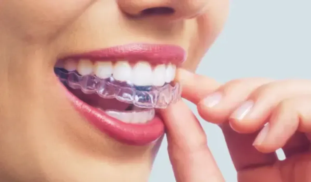 CAN YOU Wear Invisalign With Crowns