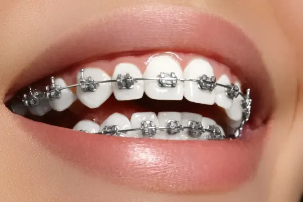 adult braces colors