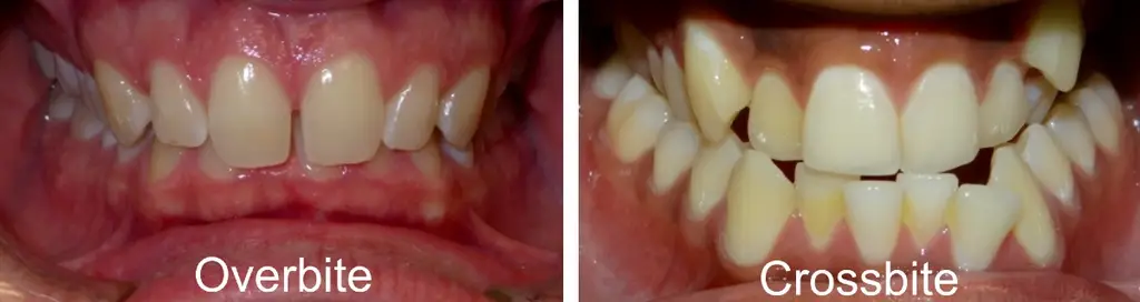 overbite vs crossbite