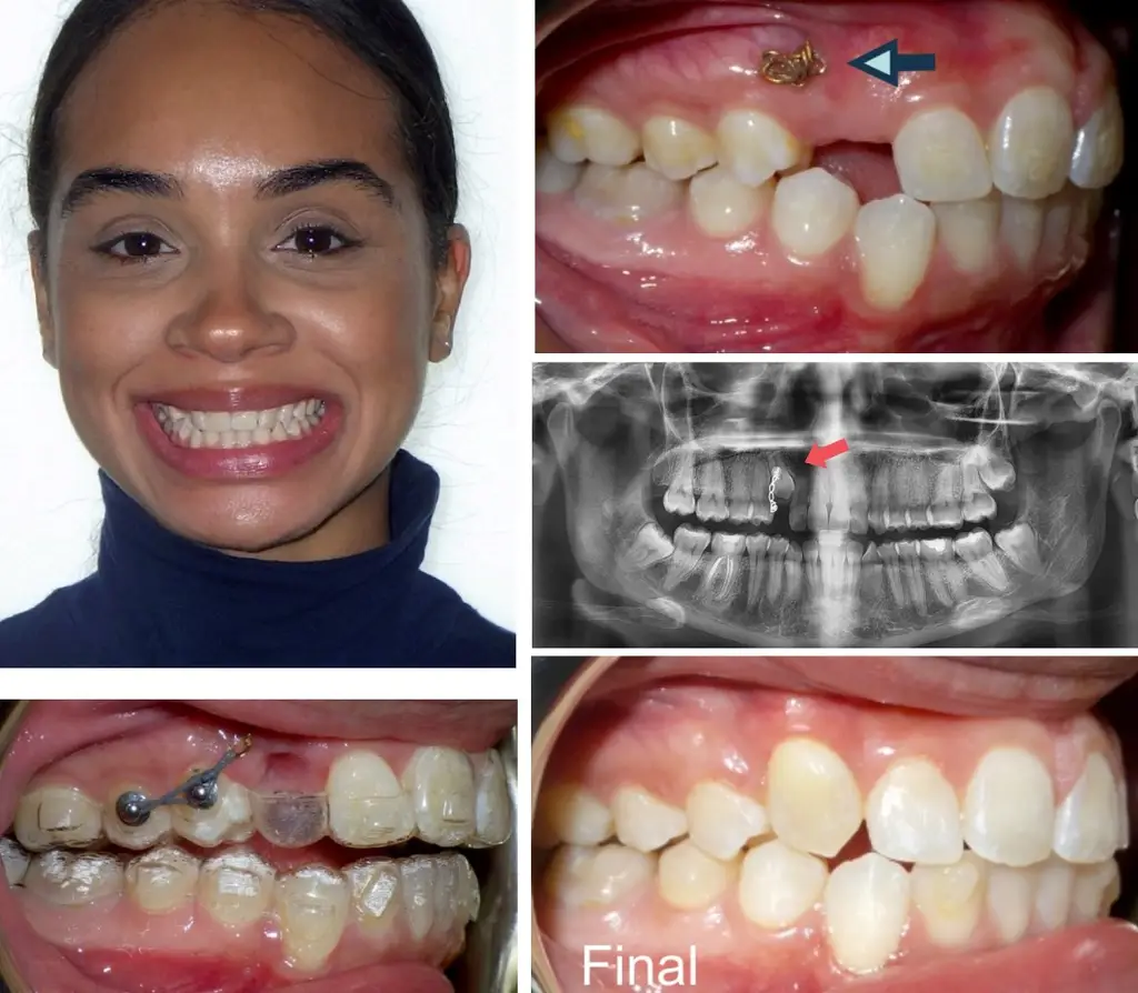 Female Years Old with Impacted Teeth Before and After Invisalign Treatment