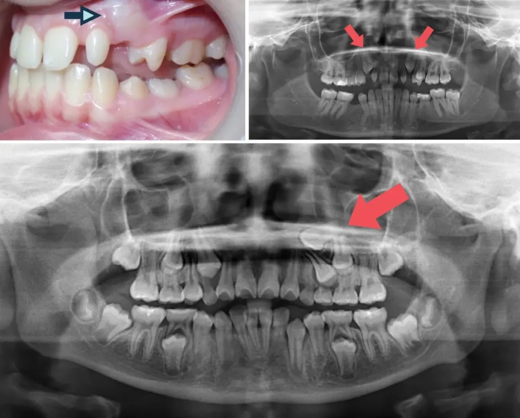 What Are Impacted Teeth? How To Diagnose, Treatment Methods, and More