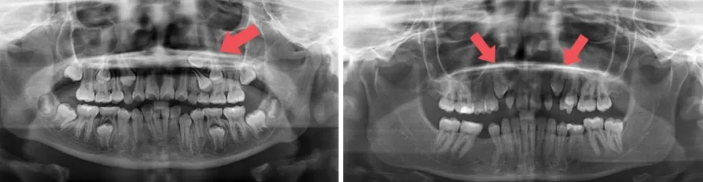 ¿CUÁLES SON LOS Signos de Dientes Impactados