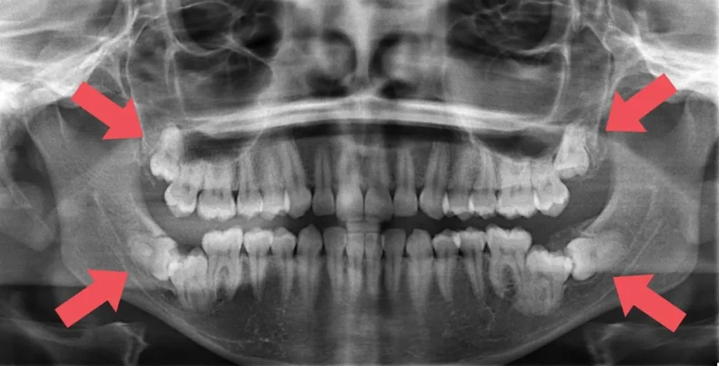 Dientes de Sabiduría Impactados