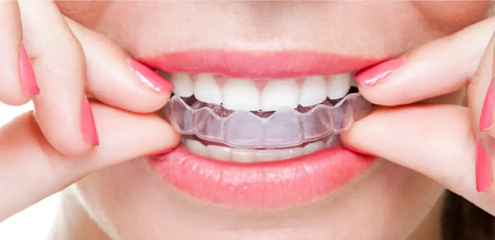 Invisalign Vivera Retainer