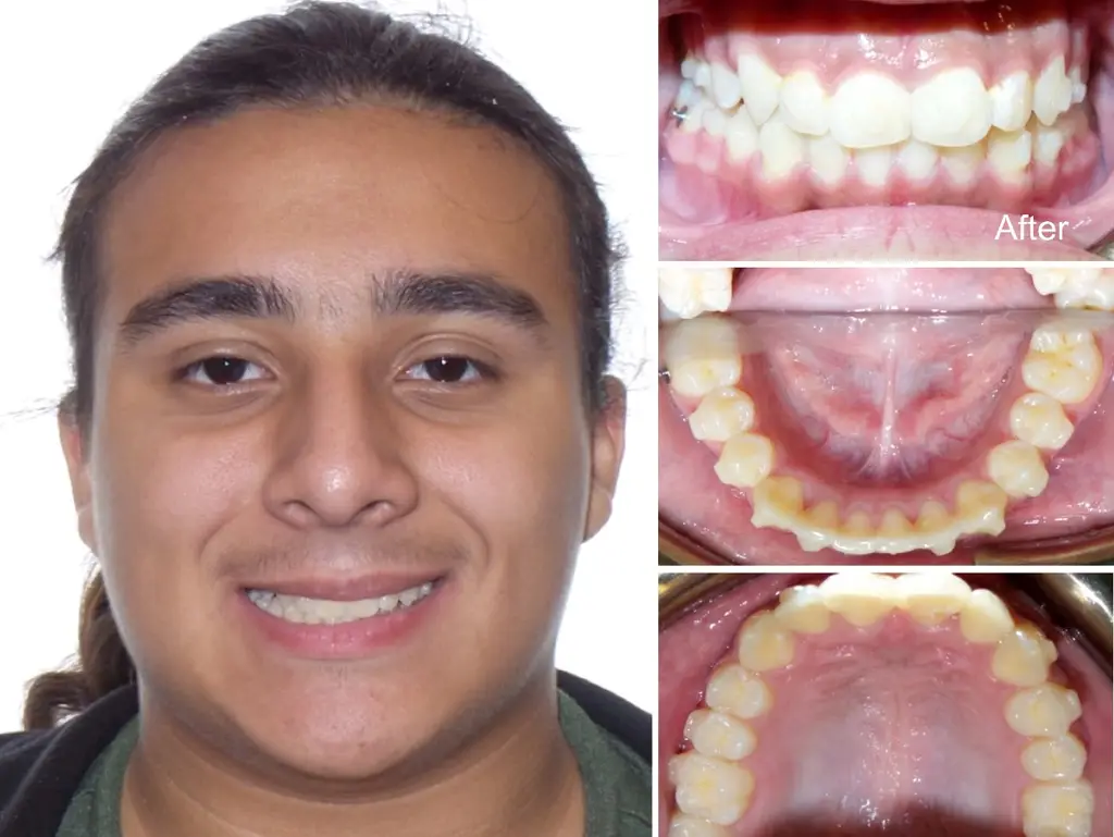 Nataniel years old Crowding casued by Overbite and Space Deficiency after Invisalign treatment