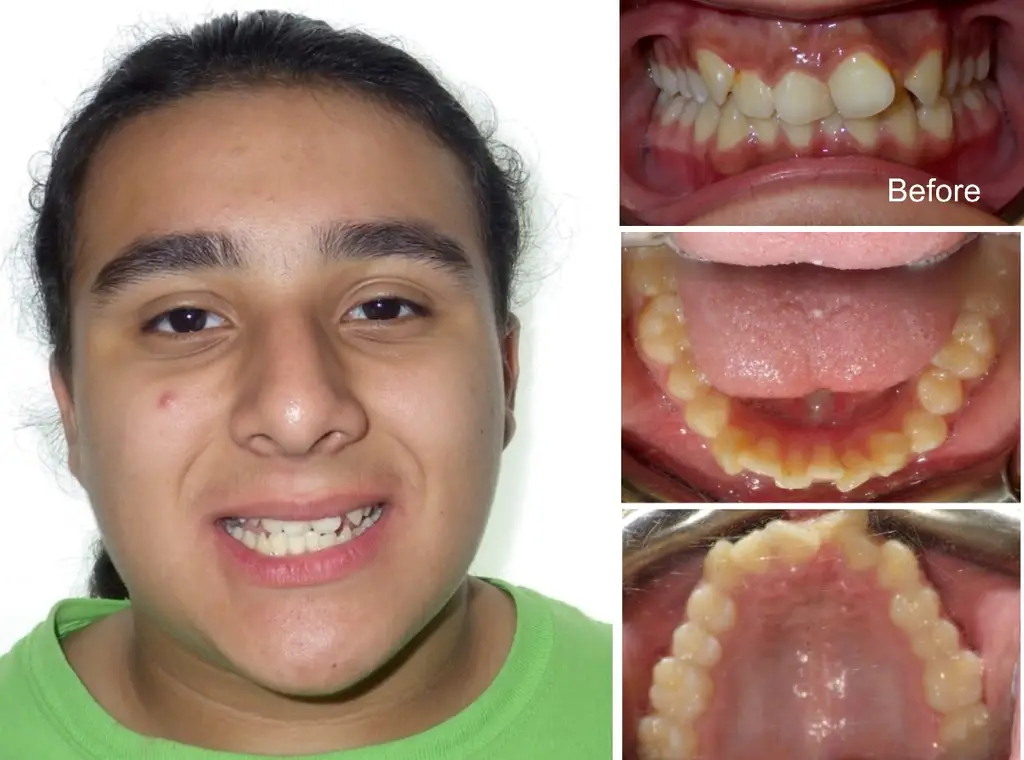 Nataniel years old Crowding casued by Overbite and Space Deficiency before Invisalign treatment