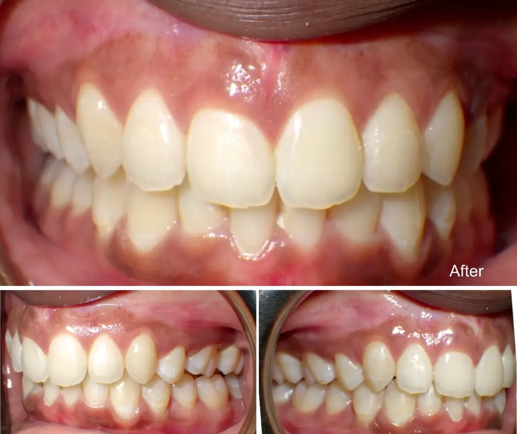 Nia years old extraction case after Invisalign treatment