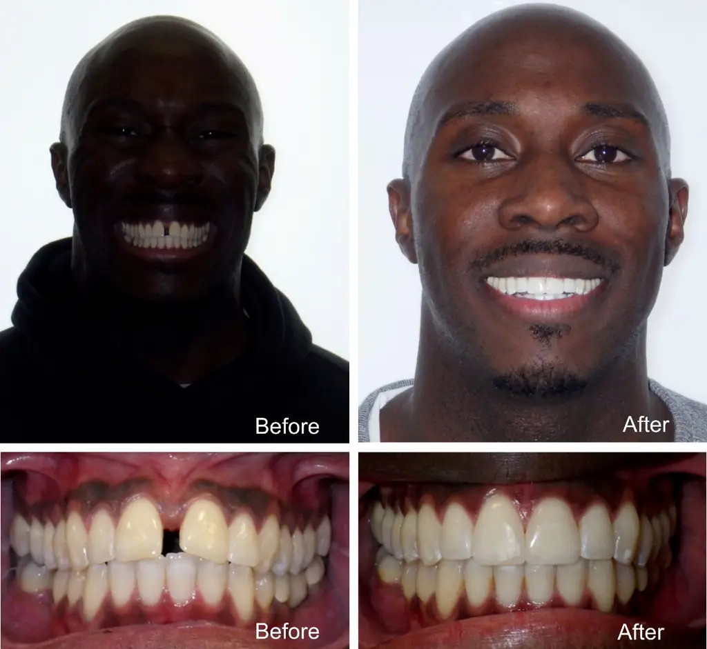 Omar years old space closure before and after Invisalign treatment