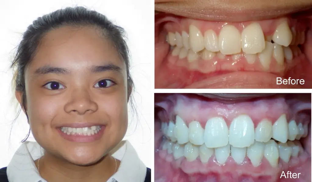 elizabeth yo with crossbite before and after Invisalign treatment