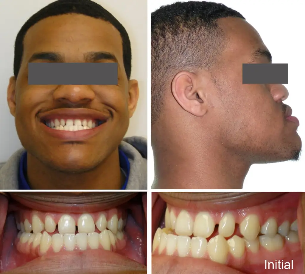 jay years old crossbite surgical case initial