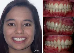 jugdeep years old overjet and overbite after invisalign treatment