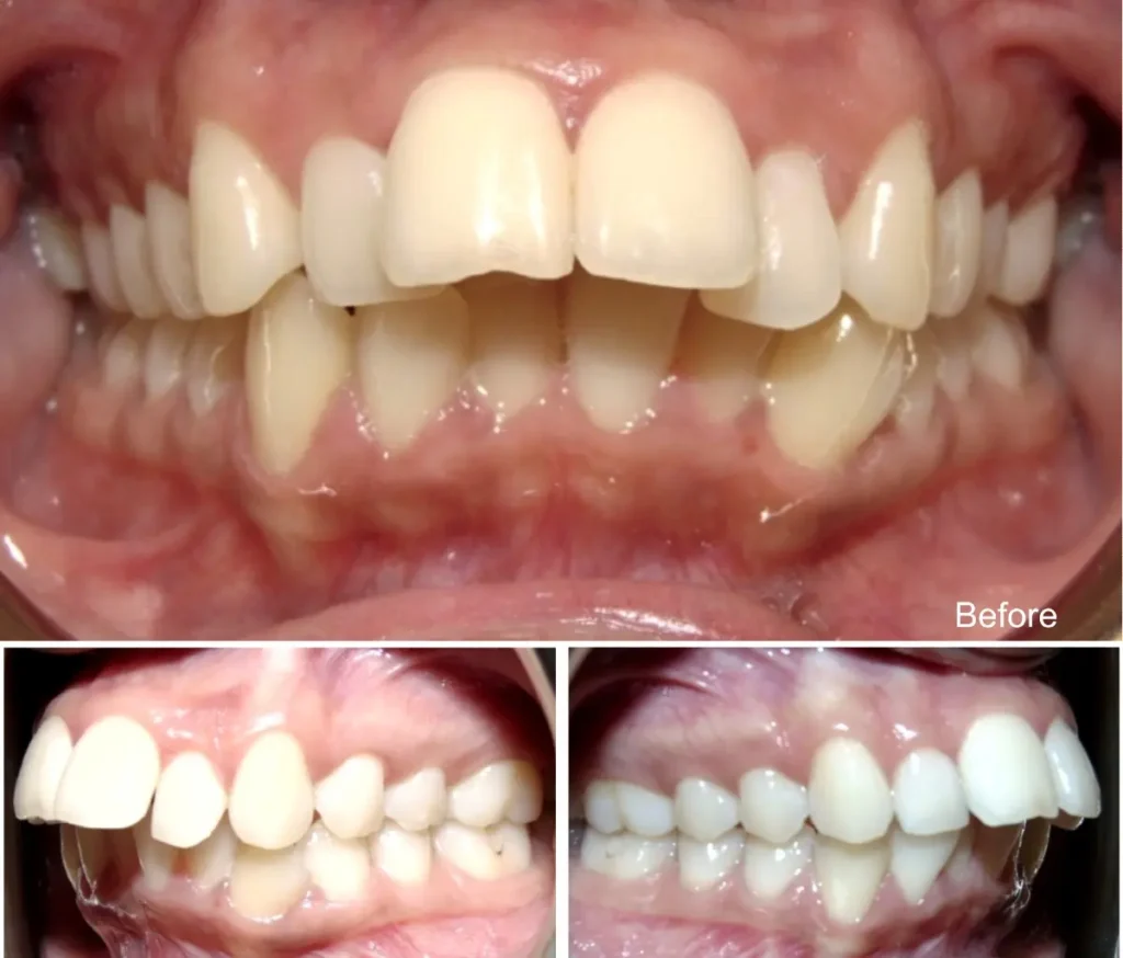 jugdeep years old overjet and overbite before invisalign treatment