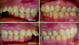 mark years old overjet correction with invisalign months treatment before and after