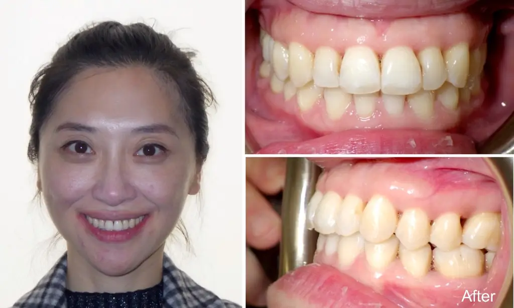 tingting years old crossbite after invisalign treatment