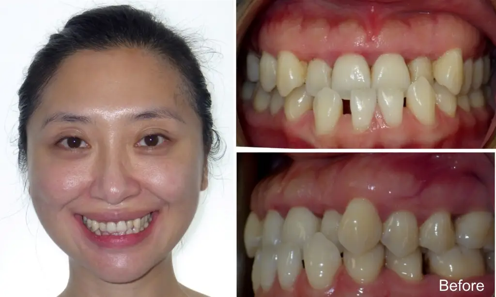 tingting years old crossbite before invisalign treatment